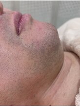 アンシュシュ(UNCHOUCHOU)/ヒゲBefore写真