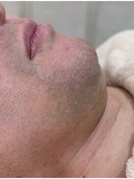 アンシュシュ(UNCHOUCHOU)/ヒゲBefore写真