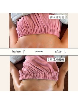 エミニナル(EMININAL)/バストケア【ビフォーアフター】