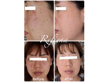 お任せください。シミケアならリフィーナへ