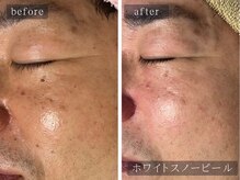 アムールサロン(Amour salon)/ホワイトスノーピール【新宿】