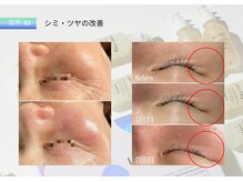 1回でしっかり結果◎艶ハリ/トーン↑/毛穴レスが叶うピーリング