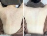 【背中ニキビケア・ザラザラ】　原因がわかる!!背中エステ当日施術相談¥13000
