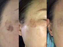 ラシュシュ(La chou chou)/剥がすシミケア