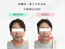 美容整体ウェリナ 名駅院/.【小顔矯正before→after】