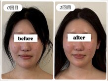 キプラ 福津店(KIPURA)/小顔矯正+毛穴洗浄+リジュラン♪