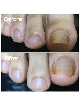 プラスキュア 用賀店(+CURE)/肥厚爪 変形爪 副爪 60分6600~