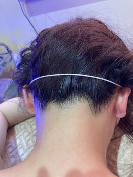 ルアナ(LUANA)/うなじ脱毛(Sパーツ)