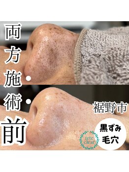 ジューンブライド(June Bride 61)/毛穴ケア