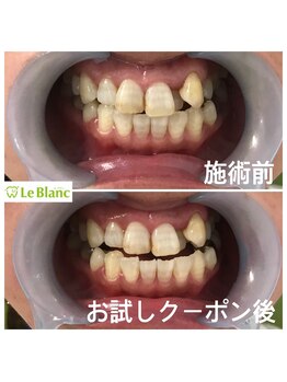 ルブラン 奈良店(Le Blanc)/ケア歯を見るのが楽しみに。