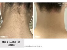 リネ(Rine)/before→after