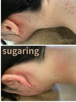 メンスエトマヌス(Mens et Manus)/うなじシュガーリング脱毛