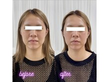 アネラ 南森町(ANERA)/小顔矯正×毛穴洗浄×南森町