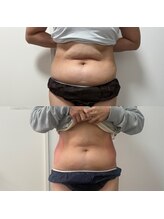 ミージュ(Miiju.)/何をしても痩せなかった部分に