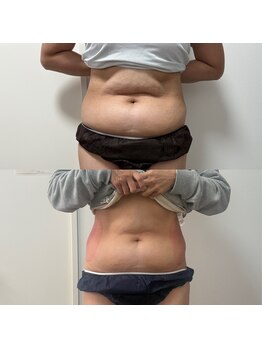 ミージュ(Miiju.)/何をしても痩せなかった部分に