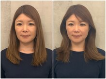 ア ニュームーン 京都烏丸店(a New Moon)/小顔矯正4回ビフォーアフター