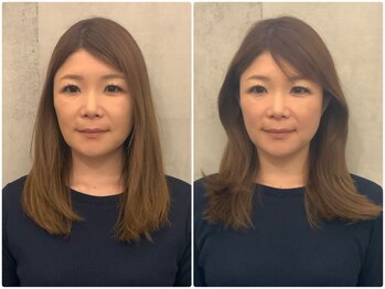 ア ニュームーン 京都烏丸店(a New Moon)/小顔矯正4回ビフォーアフター