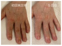 キレイテ 福岡天神店/60代/5回目【天神ハンドケア】