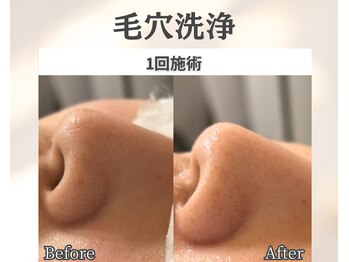 イーラボ 池袋店(e-LABO)/毛穴洗浄/ハイドロフェイシャル