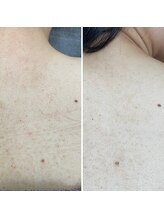 ビーボヌール(be-bonheur)/背中の肌改善