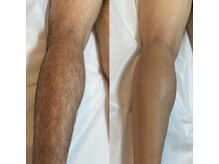 ブリッシュ(Bullish)/脚（ビフォーアフター）