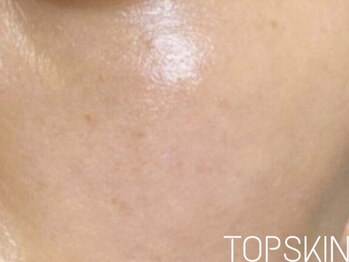 トップスキン 栄(TOPSKIN)/名古屋栄ハーブピーリング専門店