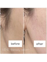 ウェヌ(VENE)/もみあげもスッキリ！