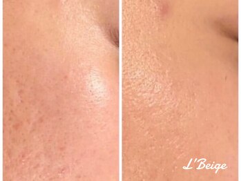レ ベージュ(L’Beige)/リアボーテ肌質改善フェイシャル