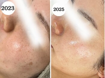 ゆらり/シミ・くすみケア