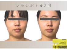 フロックス(Phlox)/小顔脂肪分解　レモンボトル