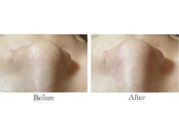 ベルーナビューティ 西新宿(Beluna beauty)/GRACE PEEL 　ビフォーアフター