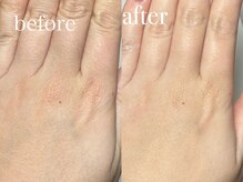 深爪矯正 爪悩み専門店 グラシナ 西宮北口店【4/3 NEW OPEN（予定）】/(深爪/長さだし/フィルイン)