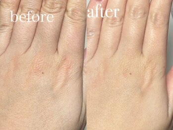 深爪矯正 爪悩み専門店 グラシナ 西宮北口店【4/3 NEW OPEN（予定）】/(深爪/長さだし/フィルイン)