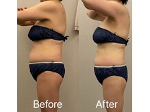 美容整体 レナトゥス 武庫之荘(Renatus)/針のいらない脂肪分解