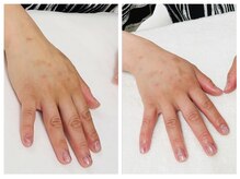 キレイテ 福岡天神店/手のくすみに悩まれているお客様