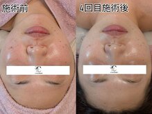 シャリル(charire)/美白・ニキビ改善