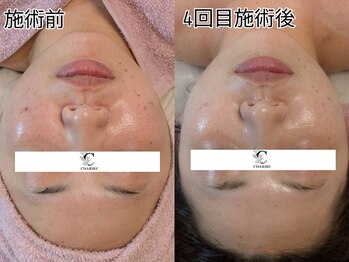 シャリル(charire)/美白・ニキビ改善