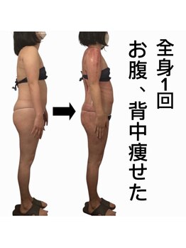 スピード美人 新宿店/スライドカッピング全身1回