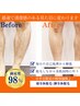 【平日限定♪/都度払い】顔全体脱毛＋脚全体脱毛　16600円→13000円