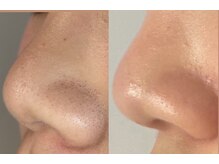 モワメーム(moi-meme)/【毛穴洗浄】小鼻のざらつき