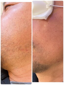 グラナダ 2F(Granada)/メンズ脱毛