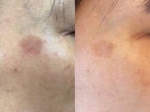 エヴェリーナ(Eveliiina)/48歳★3回シミケア