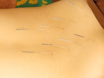 赤坂山王整骨院 鍼灸治療院 阿里山健康センター/鍼