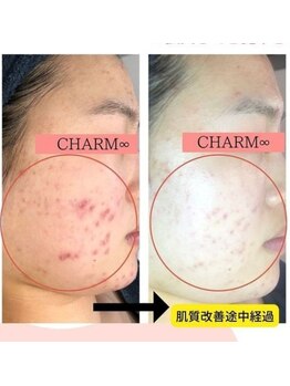 チャーム(CHARM∞)/ニキビにアプローチ！！