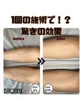 エヌ(N)/1回目から効果がわかる★