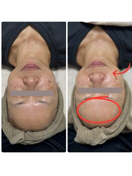 サラン(SALON)/お顔 ビフォー アフター