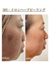 いおり骨盤整体 リブート(RE:BOOT)/ハーブピーリング