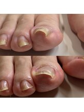 リリ(lili)/巻き爪矯正5回目（左親指）