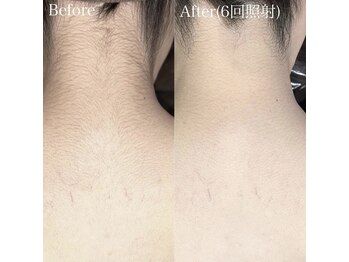 ハイリー(Hily)/うなじ before、after