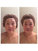 ブルームーン コルギアンドエステティック(Blue moon)/お顔コルギのbefore after